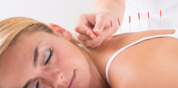 Person applying acupuncture needles into patient. Person applying acupuncture needles into patient.