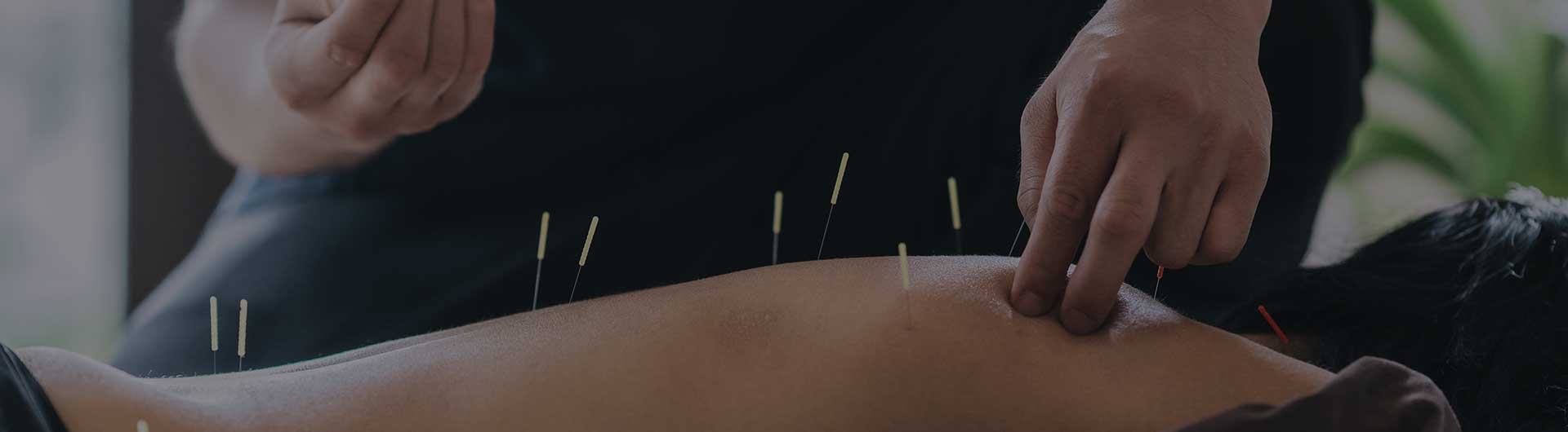 Therapist giving acupuncture treatment to a woman.