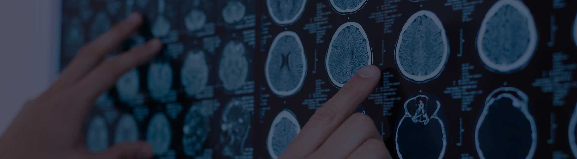 X ray images of human brain being put on the whiteboard.